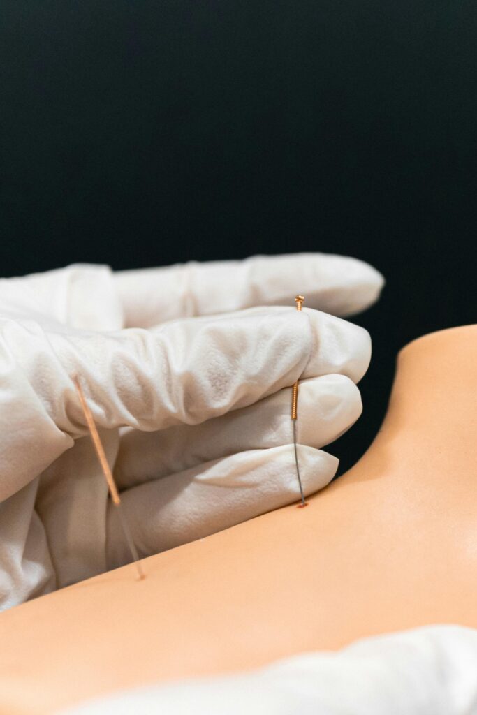 Close-up of acupuncture session demonstrating needle technique on skin for alternative therapy.